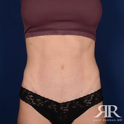 Severe Diastasis Recti Before & After Gallery - Patient 272204 - Image 2
