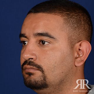 Ethnic Rhinoplasty Before & After Gallery - Patient 383855 - Image 4