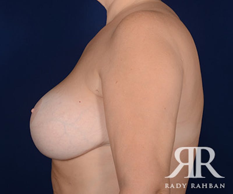 Breast Lift Before & After Gallery - Patient 752579 - Image 6