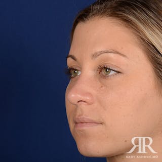 Female Rhinoplasty Before & After Gallery - Patient 205122 - Image 4