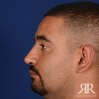 Ethnic Rhinoplasty Before & After Gallery - Patient 383855 - Image 6