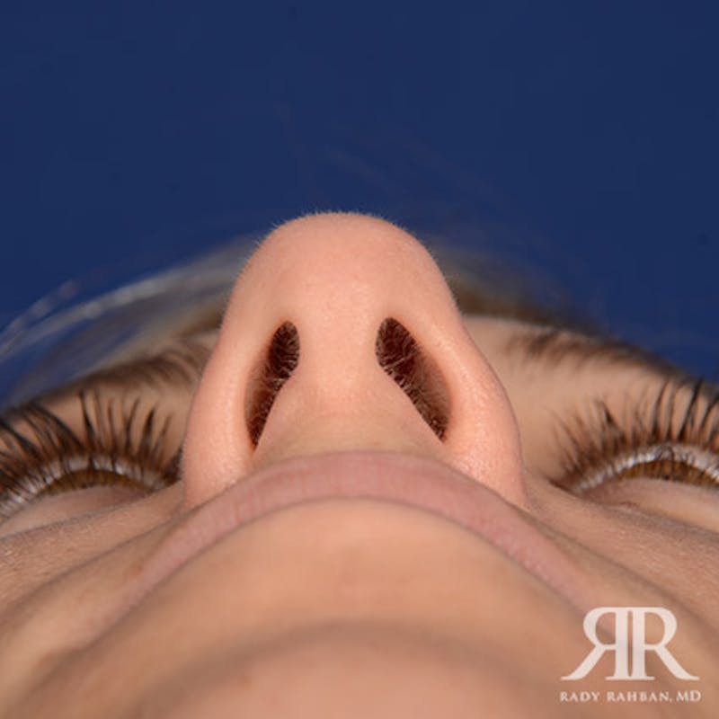 Female Rhinoplasty Before & After Gallery - Patient 205122 - Image 7