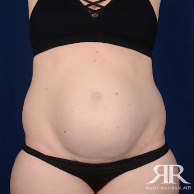 Severe Diastasis Recti Before & After Gallery - Patient 483157 - Image 1