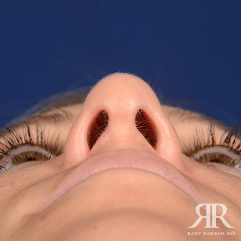 Female Rhinoplasty Before & After Gallery - Patient 205122 - Image 8
