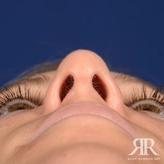 Female Rhinoplasty Before & After Gallery - Patient 205122 - Image 8
