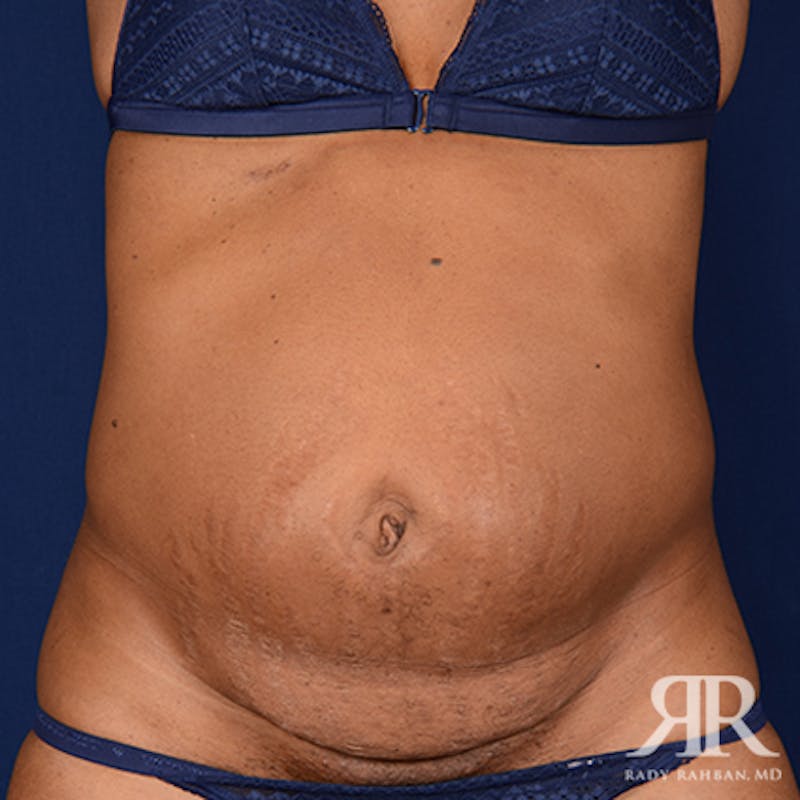 Tummy Tuck Before & After Gallery - Patient 321730 - Image 1
