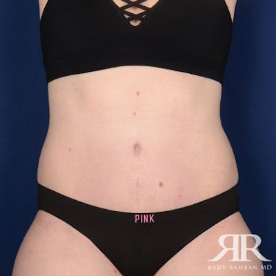 Severe Diastasis Recti Before & After Gallery - Patient 483157 - Image 2