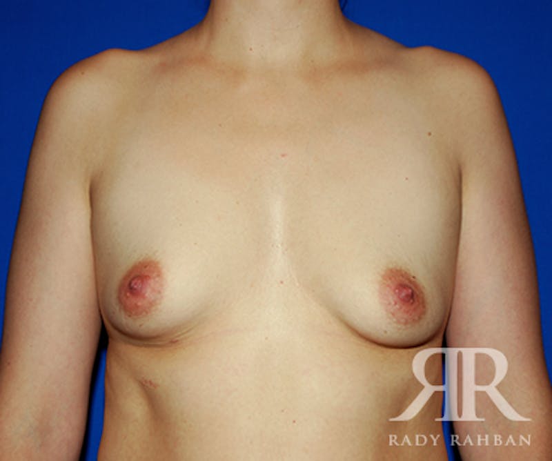 Breast Augmentation Before & After Gallery - Patient 127430 - Image 1