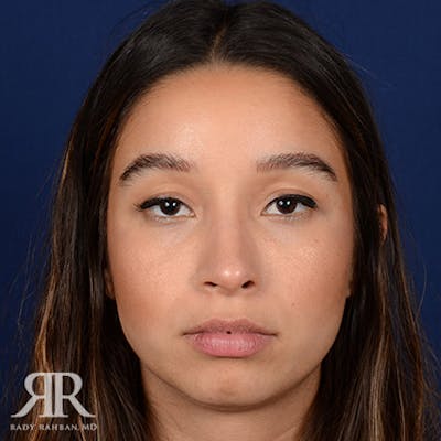 Female Rhinoplasty Before & After Gallery - Patient 100862 - Image 2