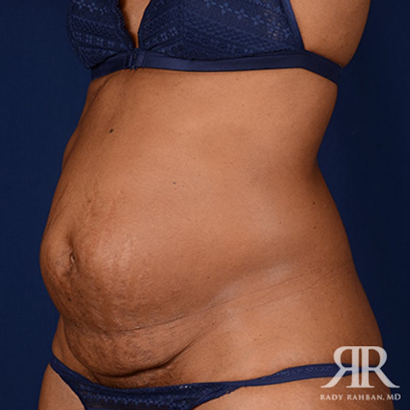 Tummy Tuck Before & After Gallery - Patient 321730 - Image 3
