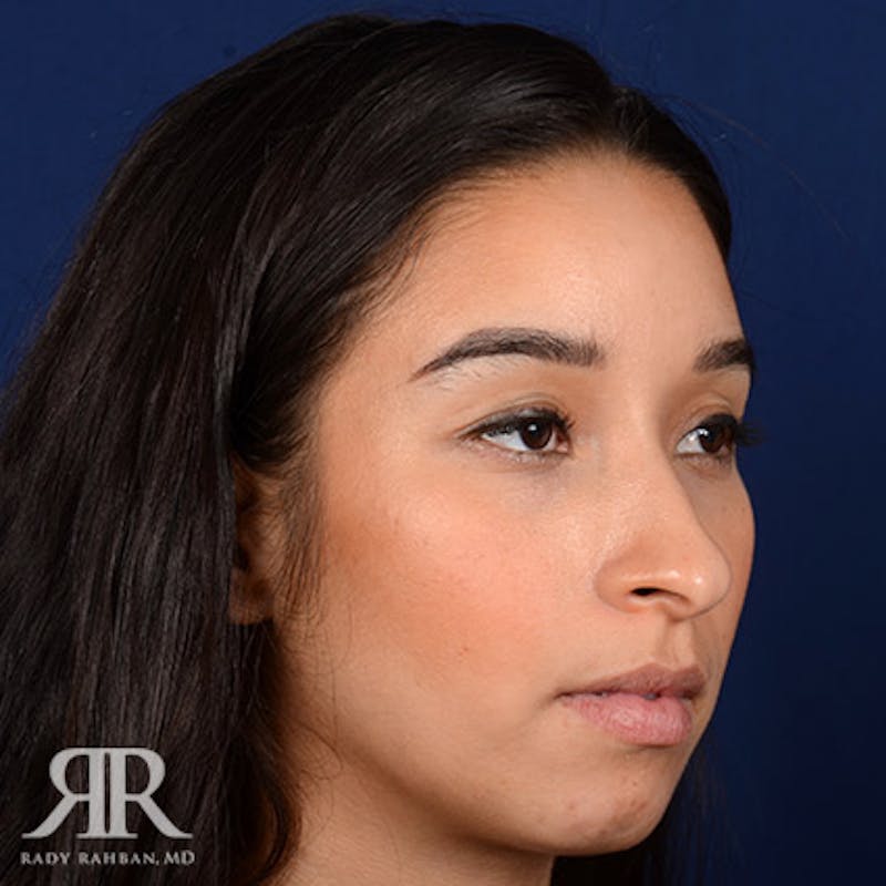 Female Rhinoplasty Before & After Gallery - Patient 100862 - Image 3