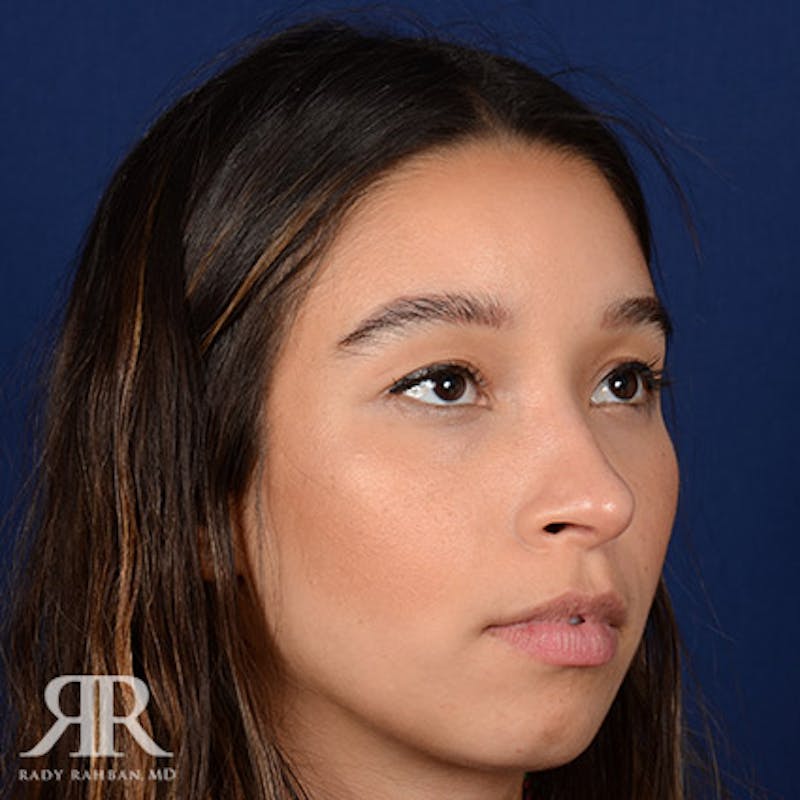 Female Rhinoplasty Before & After Gallery - Patient 100862 - Image 4