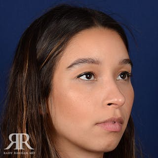 Female Rhinoplasty Before & After Gallery - Patient 100862 - Image 4