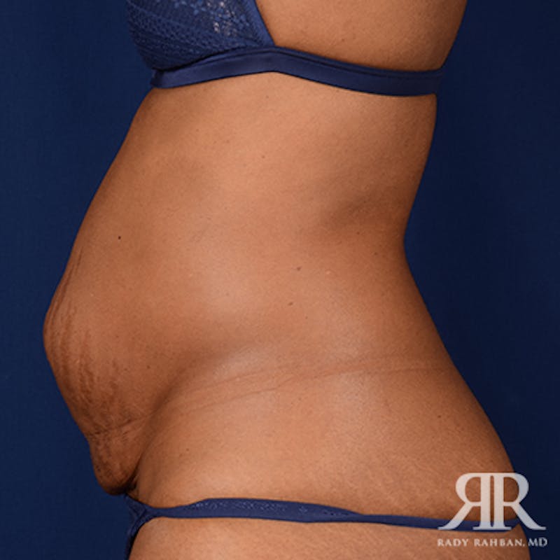 Tummy Tuck Before & After Gallery - Patient 321730 - Image 5