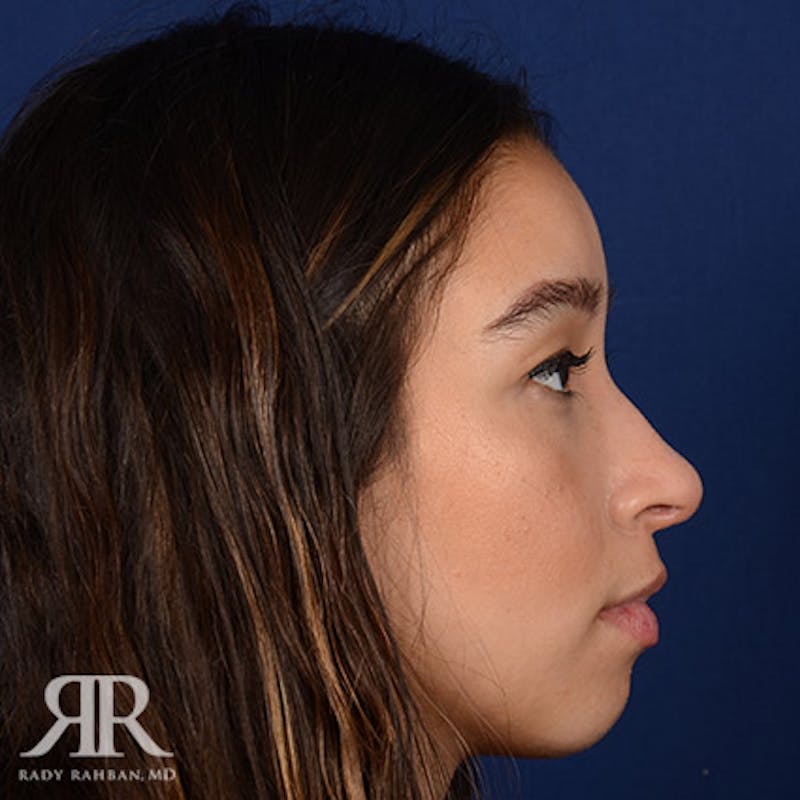 Female Rhinoplasty Before & After Gallery - Patient 100862 - Image 6