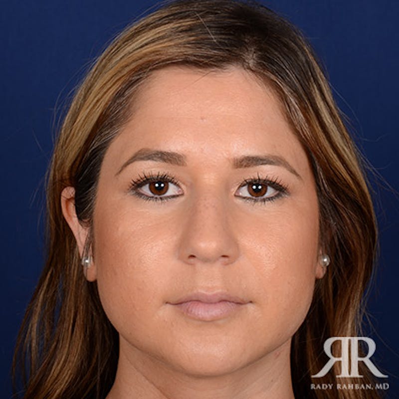 Ethnic Rhinoplasty Before & After Gallery - Patient 408487 - Image 1