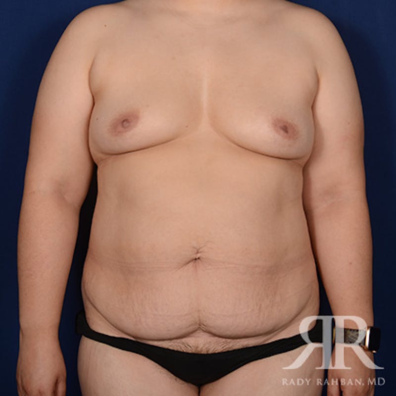 Mommy Makeover Before & After Gallery - Patient 464459 - Image 1
