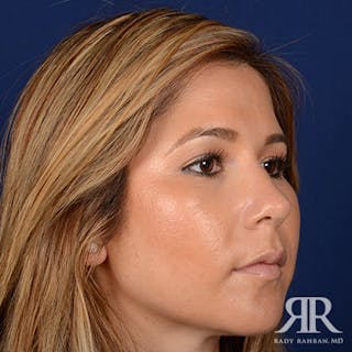 Ethnic Rhinoplasty Before & After Gallery - Patient 408487 - Image 4