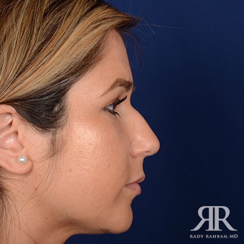 Ethnic Rhinoplasty Before & After Gallery - Patient 408487 - Image 5