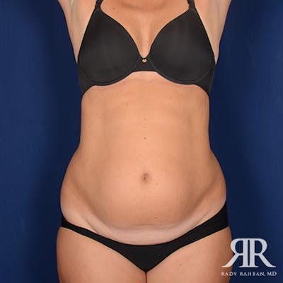 Severe Diastasis Recti Before & After Gallery - Patient 223834 - Image 1