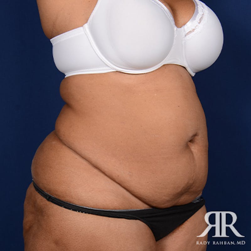 Tummy Tuck Before & After Gallery - Patient 403802 - Image 7