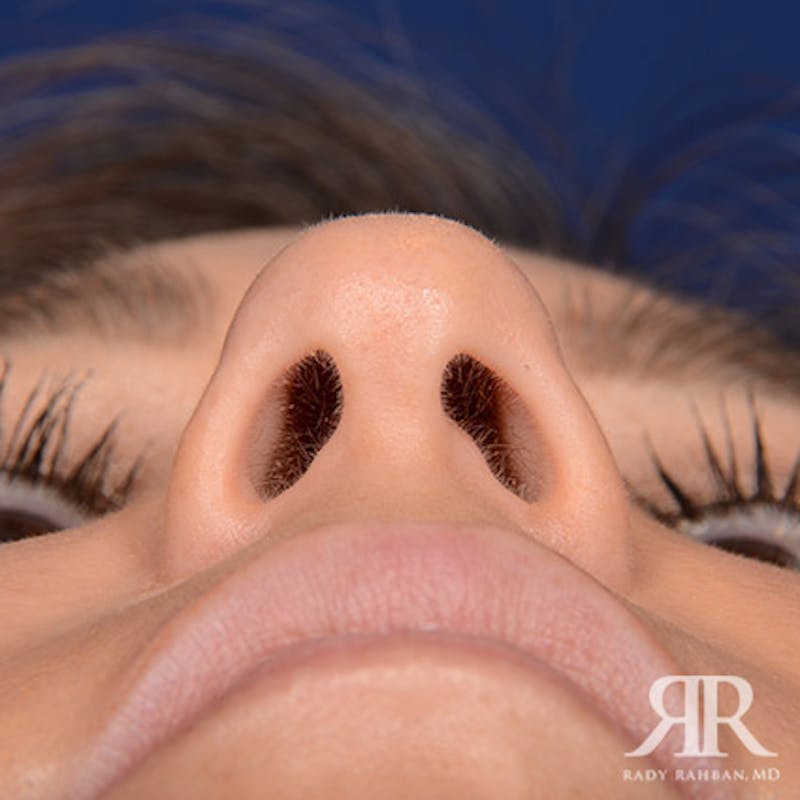 Ethnic Rhinoplasty Before & After Gallery - Patient 408487 - Image 7