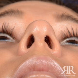 Ethnic Rhinoplasty Before & After Gallery - Patient 408487 - Image 8