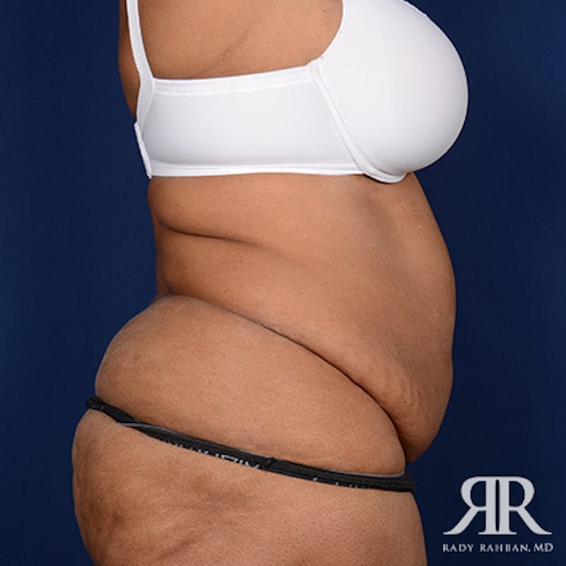 Tummy Tuck Before & After Gallery - Patient 403802 - Image 9