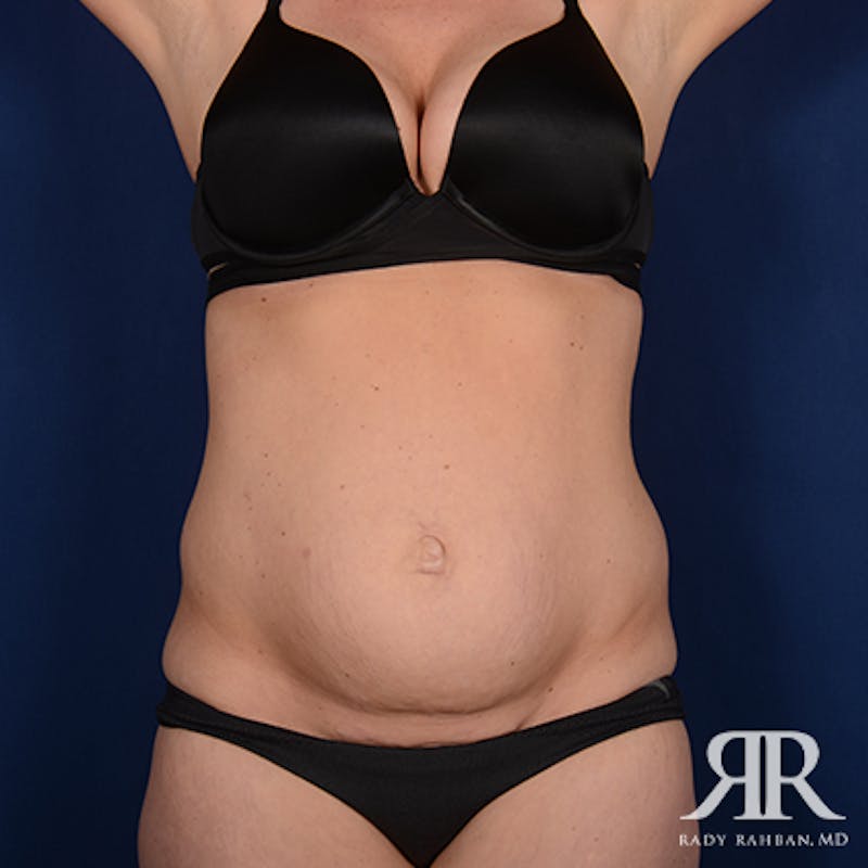 Severe Diastasis Recti Before & After Gallery - Patient 331536 - Image 1