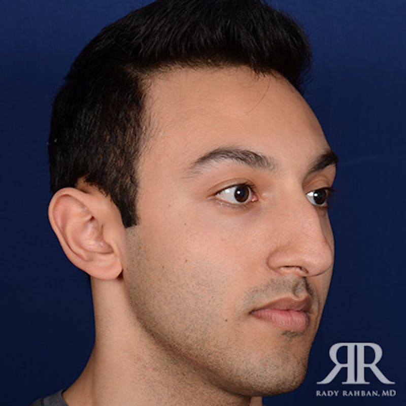Ethnic Rhinoplasty Before & After Gallery - Patient 413570 - Image 3