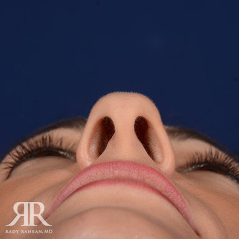 Female Rhinoplasty Before & After Gallery - Patient 394719 - Image 7