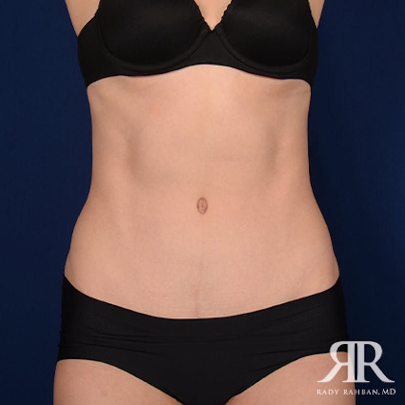 Tummy Tuck Before & After Gallery - Patient 163593 - Image 2
