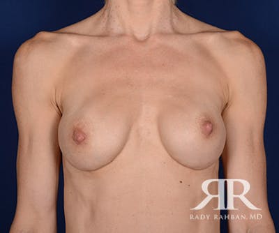 Corrective Breast Surgery Before & After Gallery - Patient 398975 - Image 1