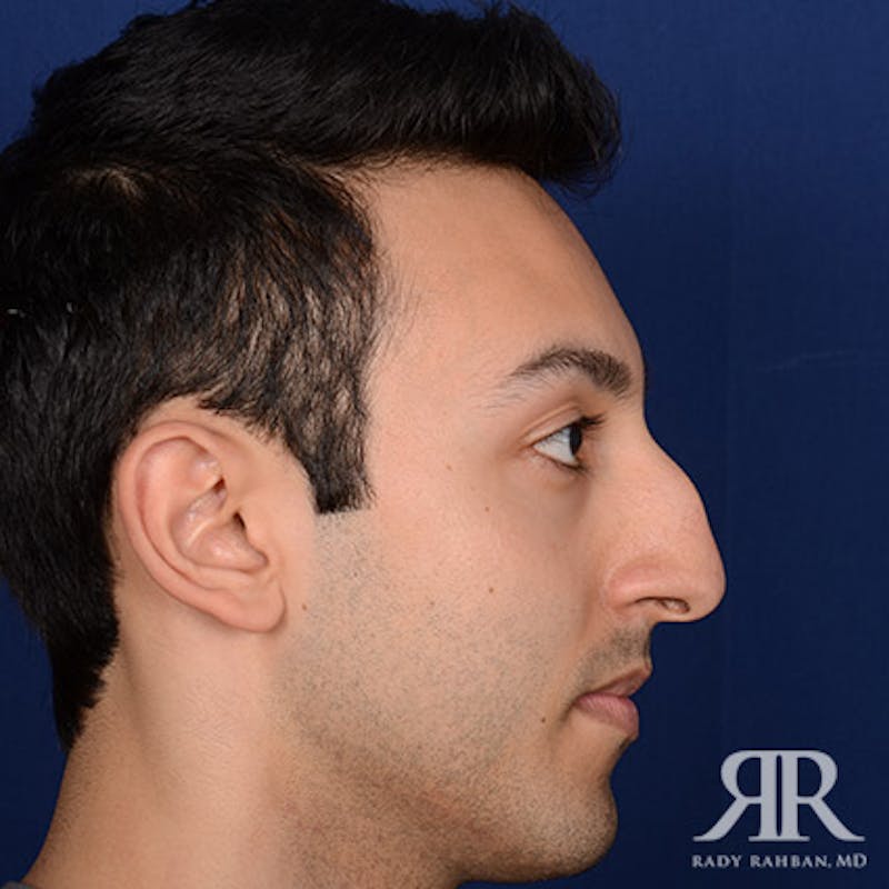 Ethnic Rhinoplasty Before & After Gallery - Patient 413570 - Image 5