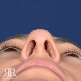 Female Rhinoplasty Before & After Gallery - Patient 394719 - Image 8