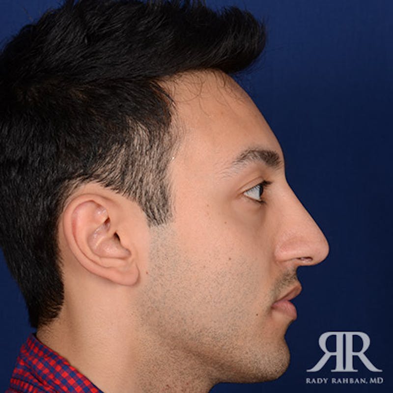 Ethnic Rhinoplasty Before & After Gallery - Patient 413570 - Image 6