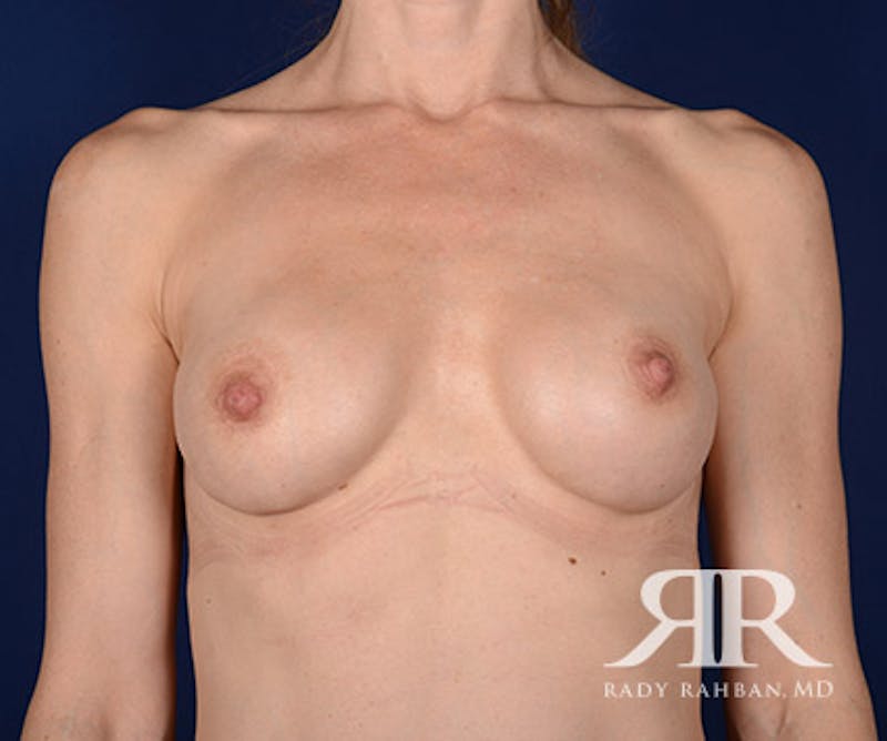 Corrective Breast Surgery Before & After Gallery - Patient 398975 - Image 2
