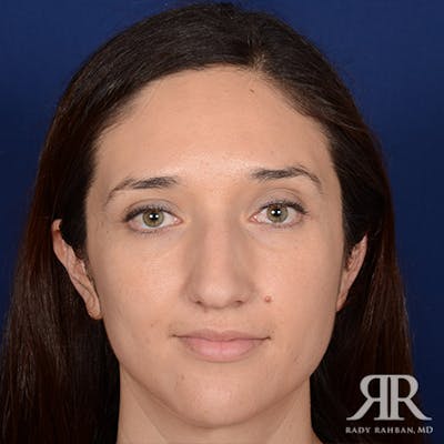 Female Rhinoplasty Before & After Gallery - Patient 235607 - Image 1