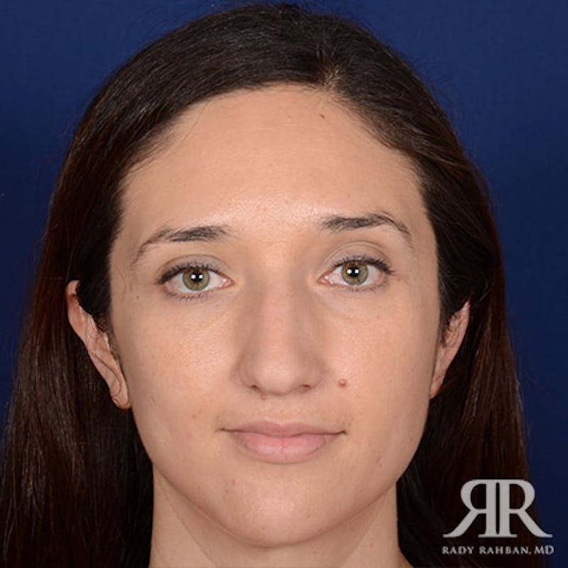 Female Rhinoplasty Before & After Gallery - Patient 235607 - Image 1