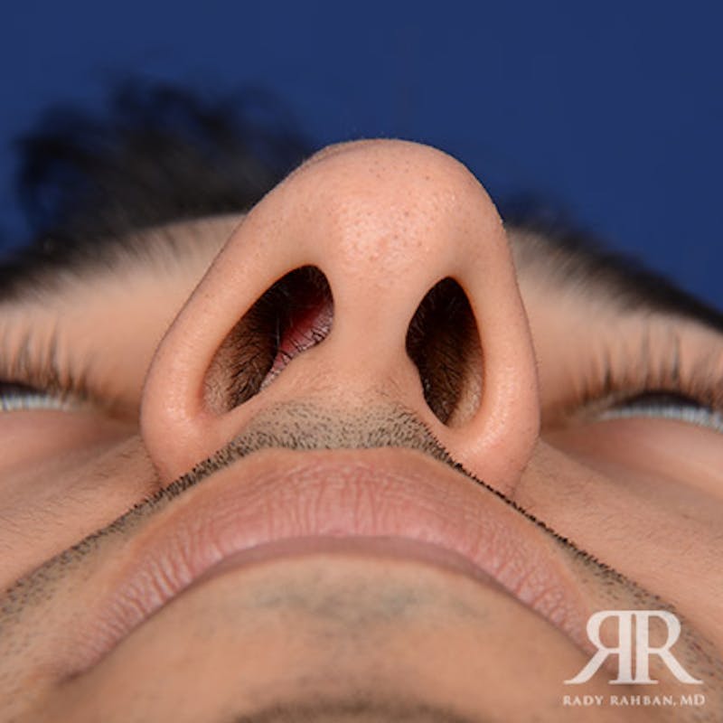 Ethnic Rhinoplasty Before & After Gallery - Patient 413570 - Image 7