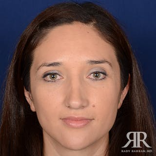 Female Rhinoplasty Before & After Gallery - Patient 235607 - Image 2