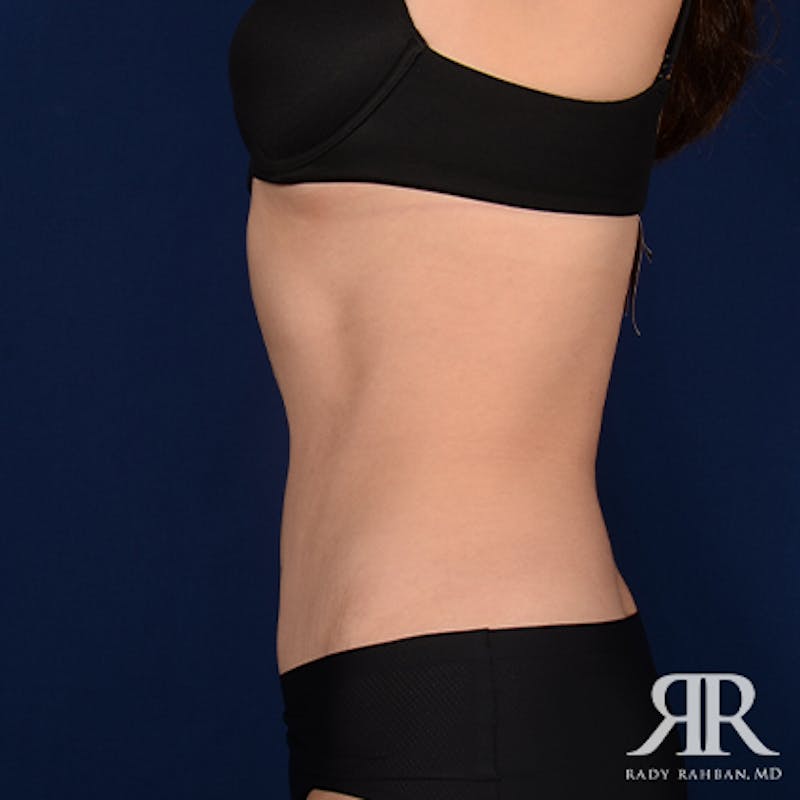 Tummy Tuck Before & After Gallery - Patient 163593 - Image 6