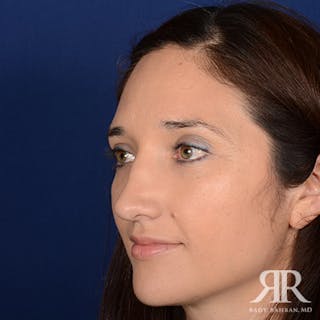 Female Rhinoplasty Before & After Gallery - Patient 235607 - Image 4