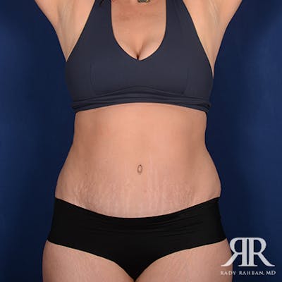 Severe Diastasis Recti Before & After Gallery - Patient 321998 - Image 2