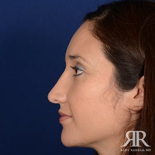 Female Rhinoplasty Before & After Gallery - Patient 235607 - Image 6