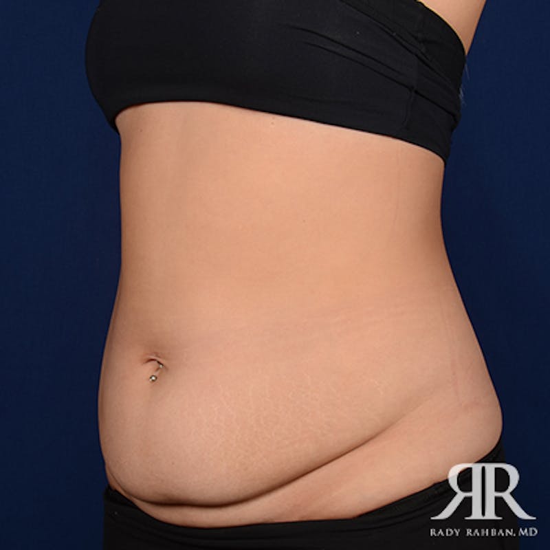 Tummy Tuck Before & After Gallery - Patient 249056 - Image 3