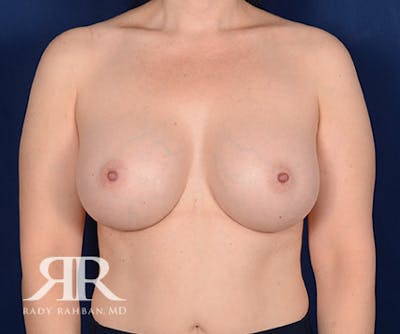 Breast Augmentation Before & After Gallery - Patient 404337 - Image 2