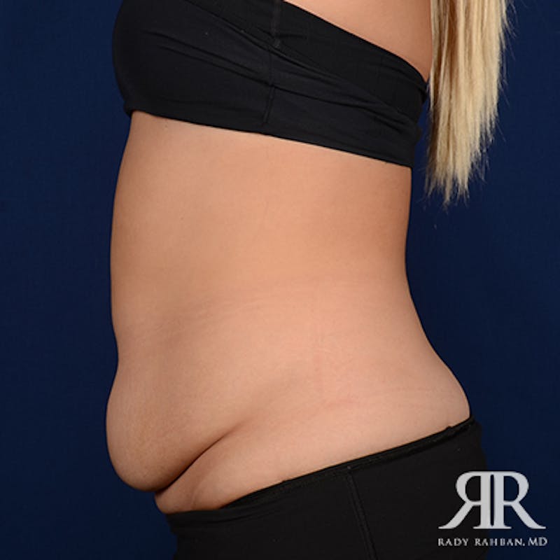 Tummy Tuck Before & After Gallery - Patient 249056 - Image 5