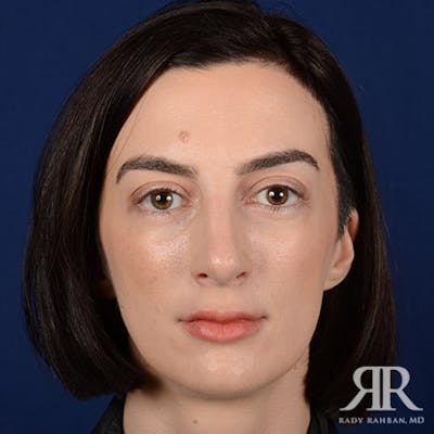 Female Rhinoplasty Before & After Gallery - Patient 315332 - Image 2