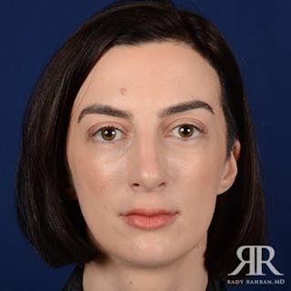 Female Rhinoplasty Before & After Gallery - Patient 315332 - Image 2